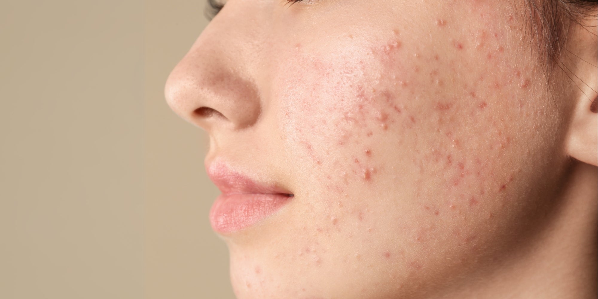 Common Skincare Mistakes That Are Damaging Your Skin